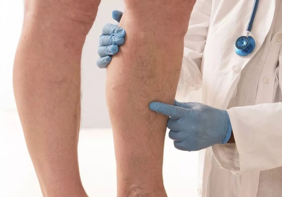 Doctor examines legs with varicose veins