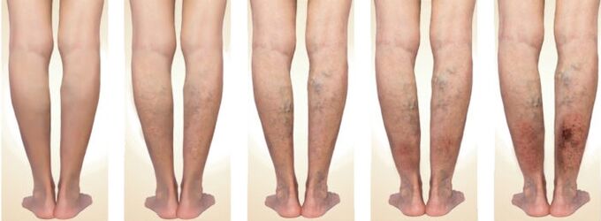 Stages of development of varicose veins