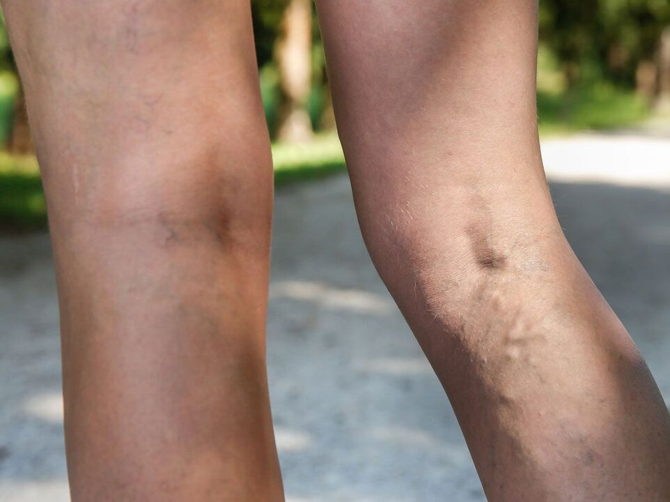 varicose veins of the legs