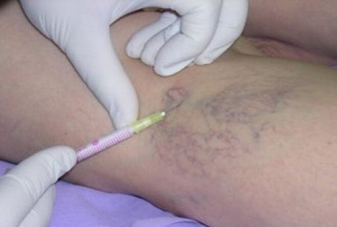 Injection for varicose veins