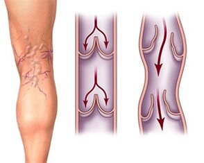 Normal valve function in a healthy vein and pathology of the valves in a varicose vein