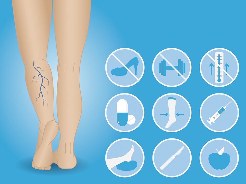 Varicose veins of the lower extremities