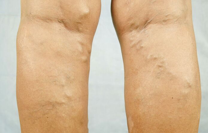 Varicose veins on the legs are a reason to see a phlebologist