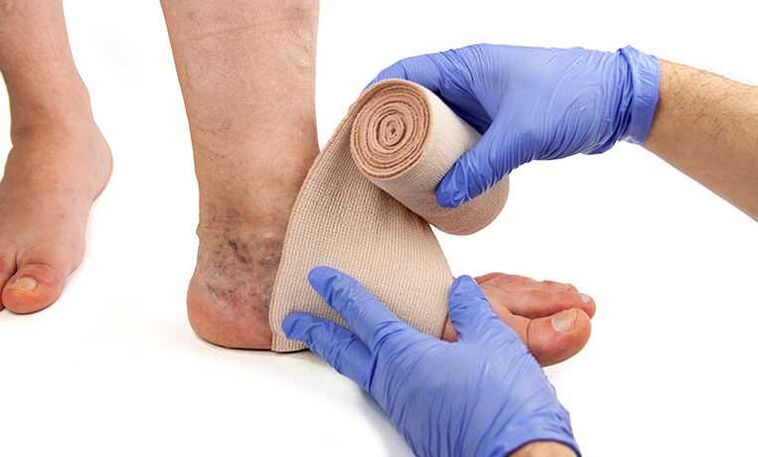 The treatment of varicose veins on the legs is supplemented by the use of compression stockings