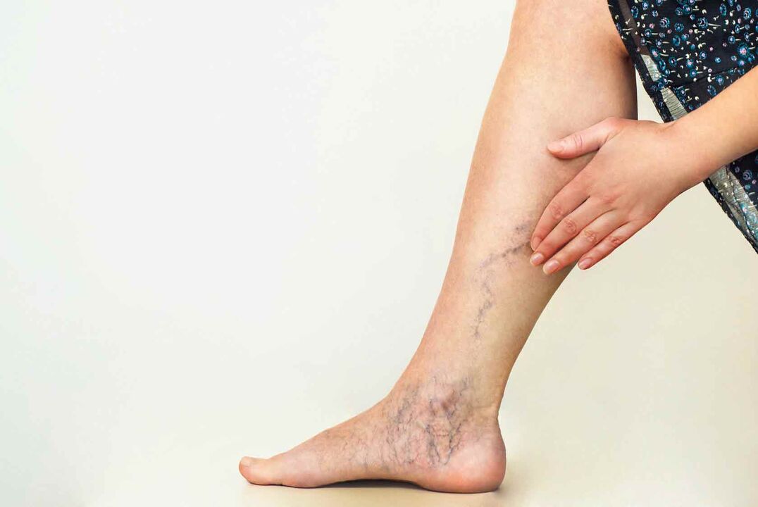 Varicose veins on women's legs