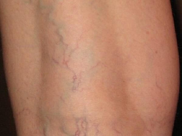 Type of varicose veins