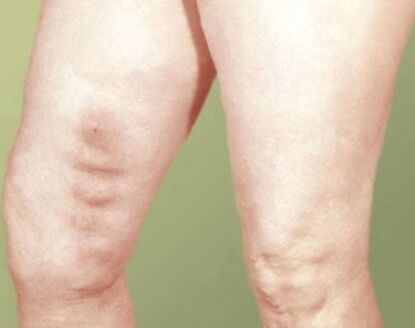 phlebitis