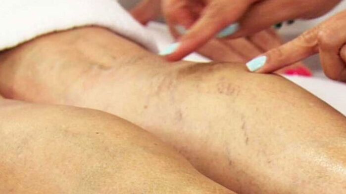 Varicose veins of the lower extremities