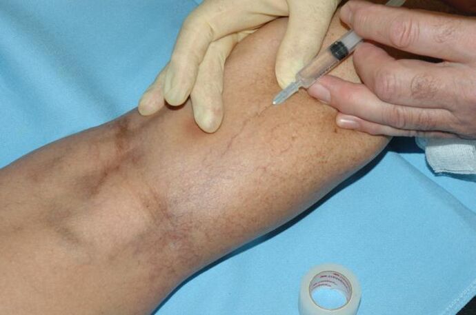 Sclerotherapy