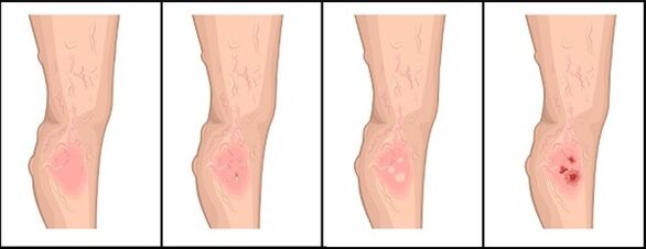 The degree of varicose veins