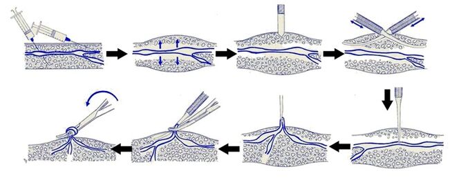 Varadi operation