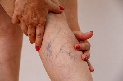 Varicose veins of the lower extremities