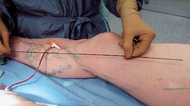 How is varicose vein surgery performed