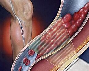 Varicose veins of the deep veins of the lower extremities