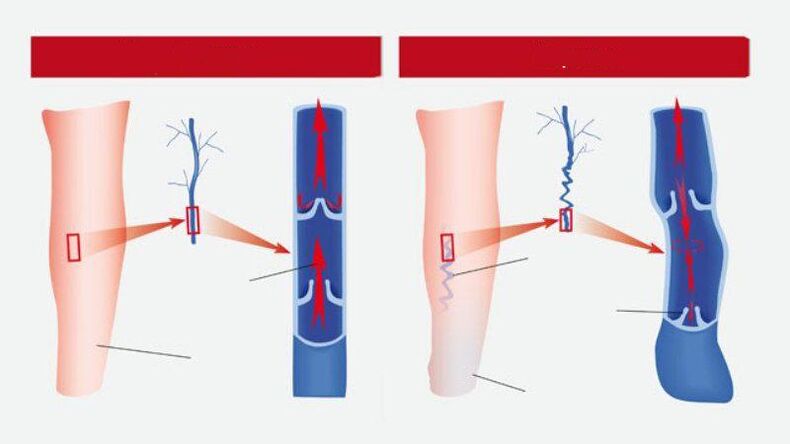 How do varicose veins look