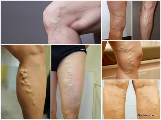 What are varicose veins