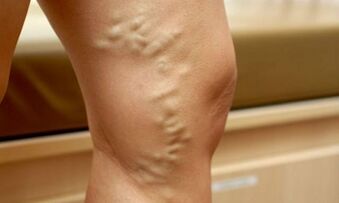 Signs and symptoms of varicose veins on the legs